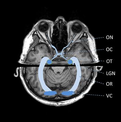 Computational approaches for the reconstruction of optic nerve fibers along the visual pathway from medical images: a comprehensive review